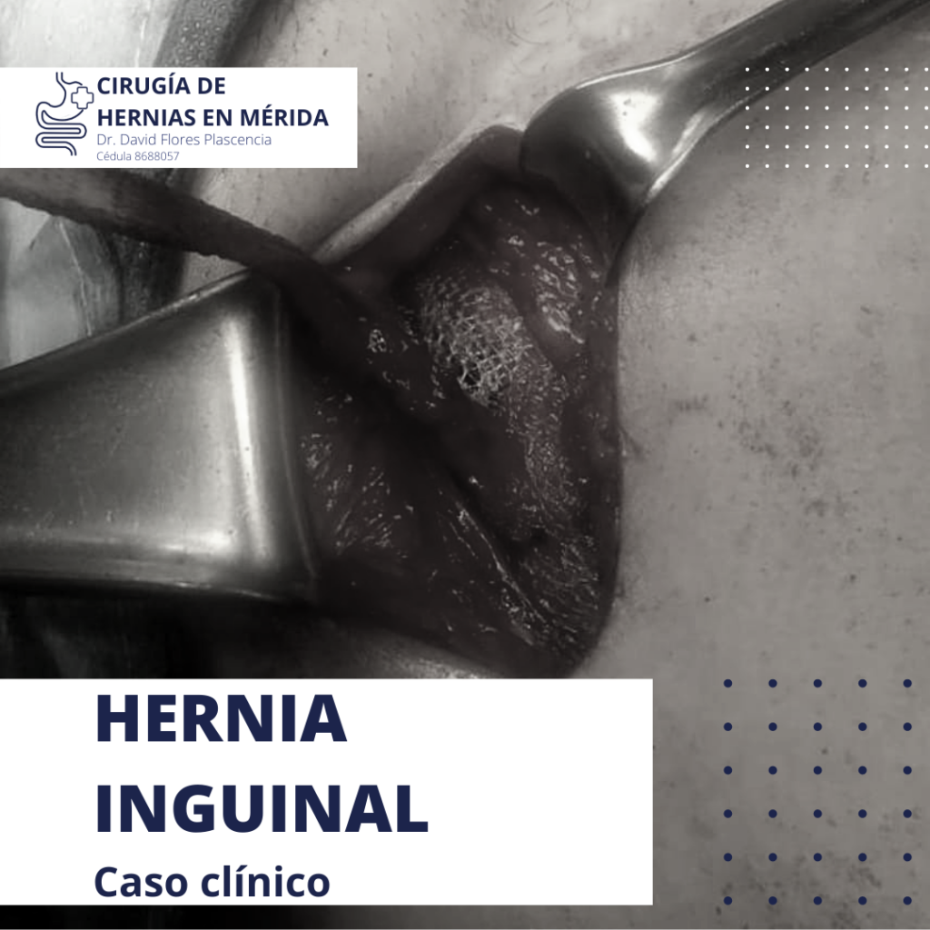 Blog Cirug A De Hernias En M Rida